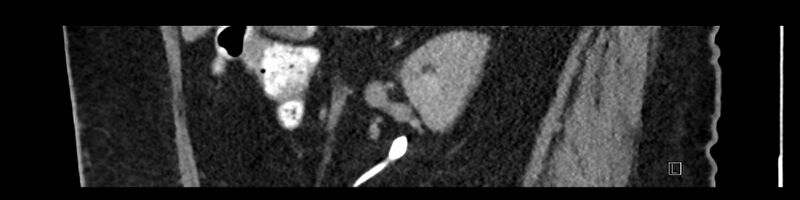 File:Buried bumper syndrome - gastrostomy tube (Radiopaedia 63843-72575 Sagittal Inject 82).jpg