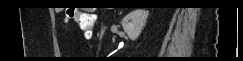 Buried bumper syndrome - gastrostomy tube (Radiopaedia 63843-72575 Sagittal Inject 82).jpg
