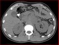 Burned-out testicular choriocarcinoma (Radiopaedia 32822-34040 Axial non-contrast 6).jpg