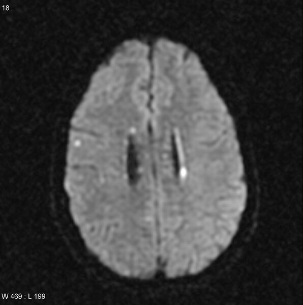 File:CMV ventriculitis and encephalitis (Radiopaedia 5416-7166 Axial DWI 7).jpg