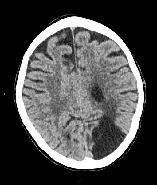 File:Calcified cerebral emboli from left ventricular thrombus (Radiopaedia 84420-99758 Axial non-contrast 33).jpg