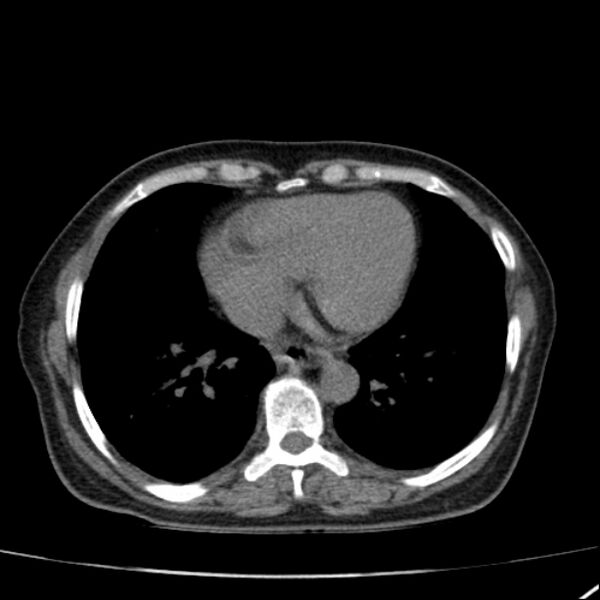 File:Calcified hepatic hydatid cyst (Radiopaedia 26872-27046 Axial non-contrast 8).jpg