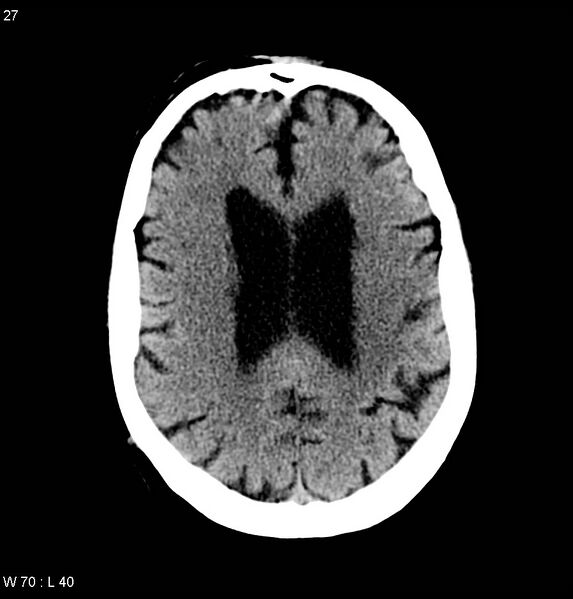 File:Calcified left middle cerebral artery embolism (Radiopaedia 5570-22120 Axial non-contrast 8).jpg