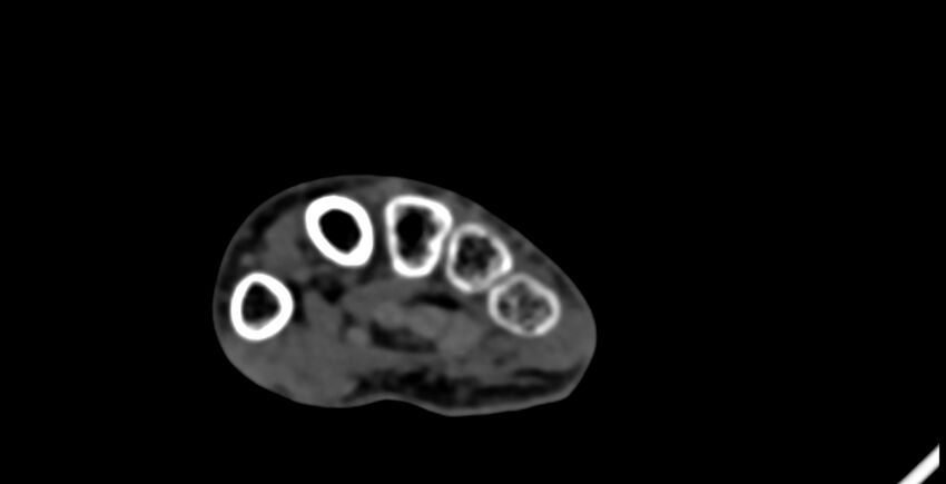 Calcifying aponeurotic fibroma (Radiopaedia 88423-105064 B 136).jpg