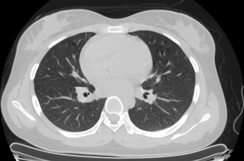 File:Cannonball metastases - uterine choriocarcinoma (Radiopaedia 70137-80173 Axial lung window 53).jpg