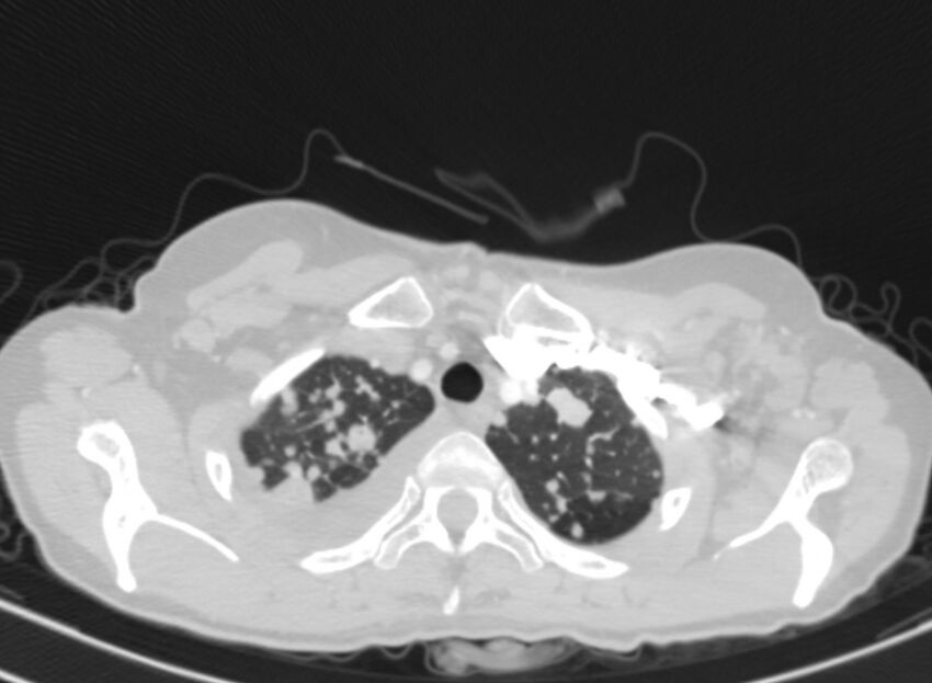 Cannonball metastases from breast cancer (Radiopaedia 91024-108569 Axial lung window 10).jpg