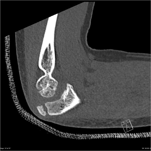 File:Capitellum fracture (Radiopaedia 23352-23426 Sagittal bone window 37).jpg