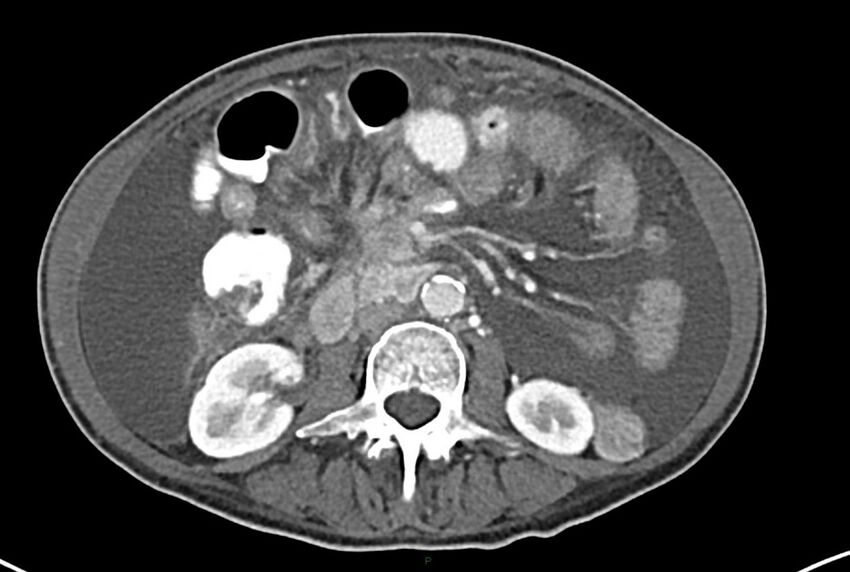 Carcinoid mesenteric tumor complicated by chylous ascites (Radiopaedia 76312-87953 A 36).jpg