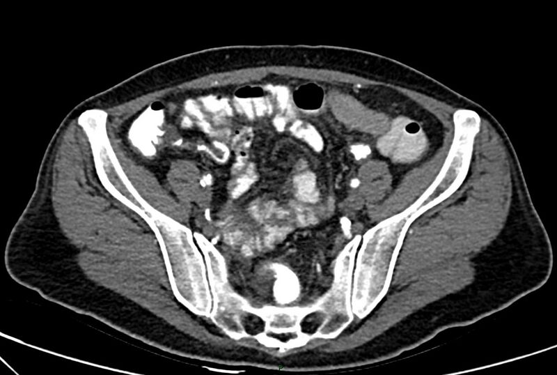 File:Carcinoid mesenteric tumor complicated by chylous ascites (Radiopaedia 76312-88926 A 57).jpg