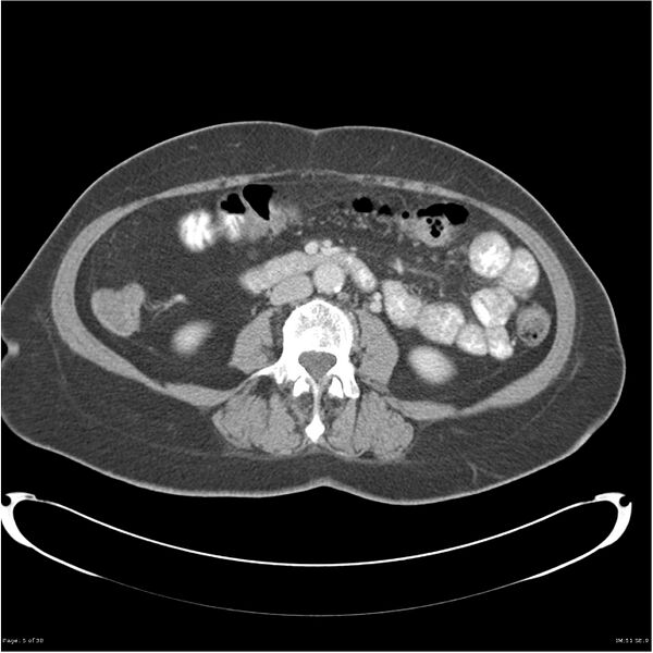 File:Carcinoid tumor of the ileum with metastasis to orbit (Radiopaedia 28165-28425 A 5).jpg