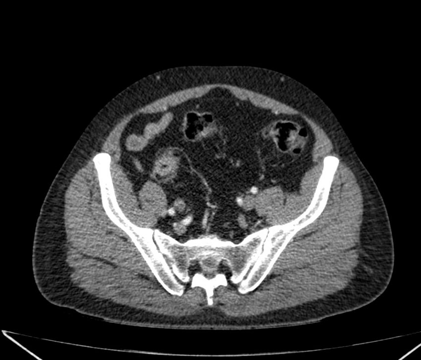 Carcinoid tumor with hepatic metastases (Radiopaedia 22651-22670 B 79).jpg