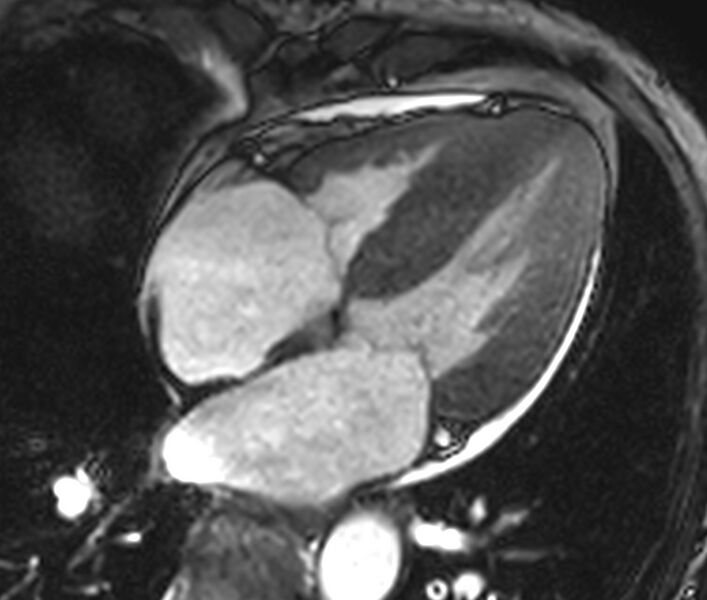 File:Cardiac amyloidosis (Radiopaedia 39736-42124 D 10).jpg