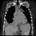Cardiogenic pulmonary edema (Radiopaedia 29213-29609 Coronal non-contrast 18).jpg