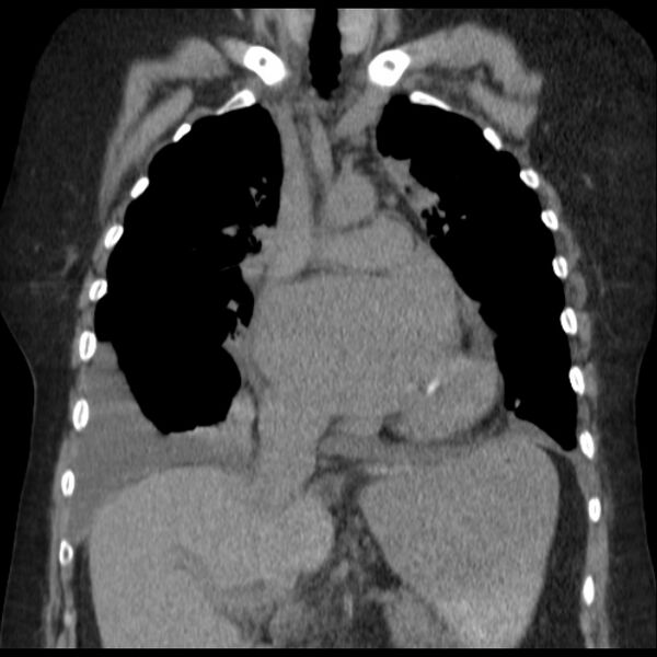 File:Cardiogenic pulmonary edema (Radiopaedia 29213-29609 Coronal non-contrast 18).jpg