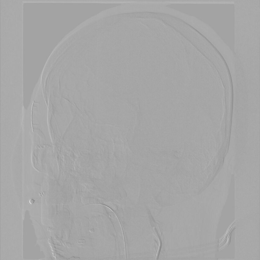 Caroticocavernous fistula - direct (Radiopaedia 61660-69666 Oblique Left ICA 8).jpg