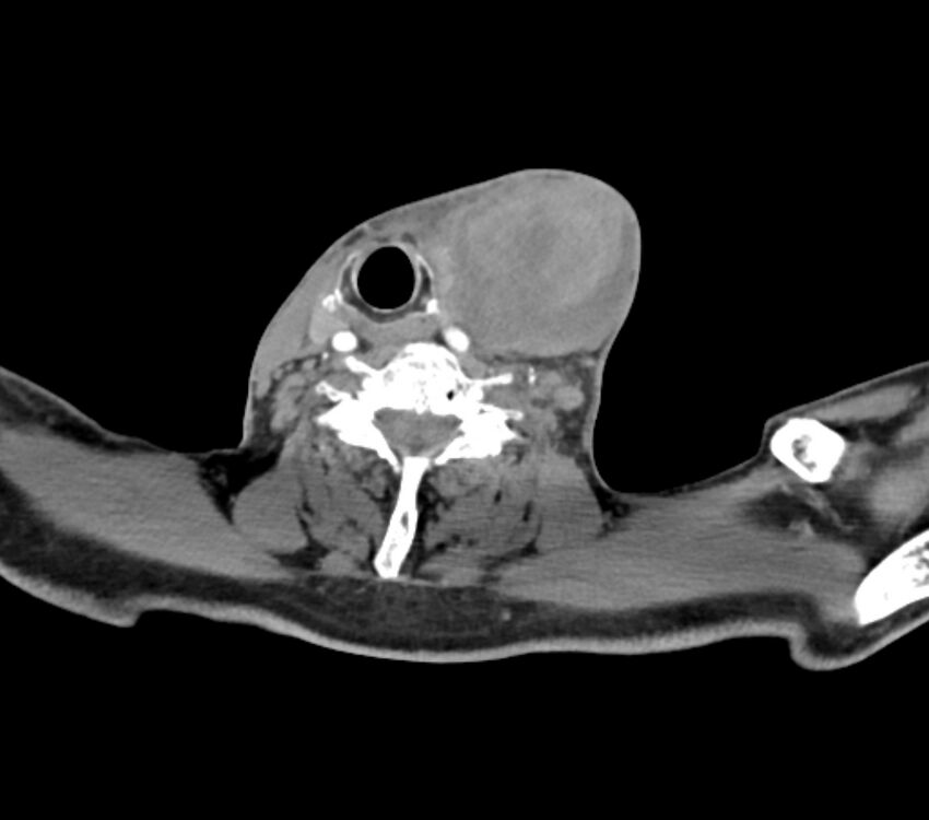 Carotid artery pseudoaneurysm (Radiopaedia 84030-99259 C 57).jpg