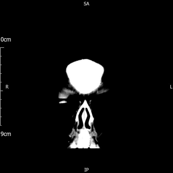 File:Cavernous sinus thrombosis (Radiopaedia 79414-92510 Coronal Brain 11).jpg