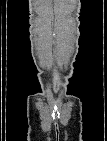 File:Cavernous transformation of portal vein (Radiopaedia 88540-105207 B 71).jpg
