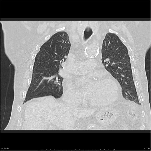 File:Cavitating left lower lobe lesion - squamous cell lung cancer (Radiopaedia 27749-28176 Coronal lung window 24).jpg