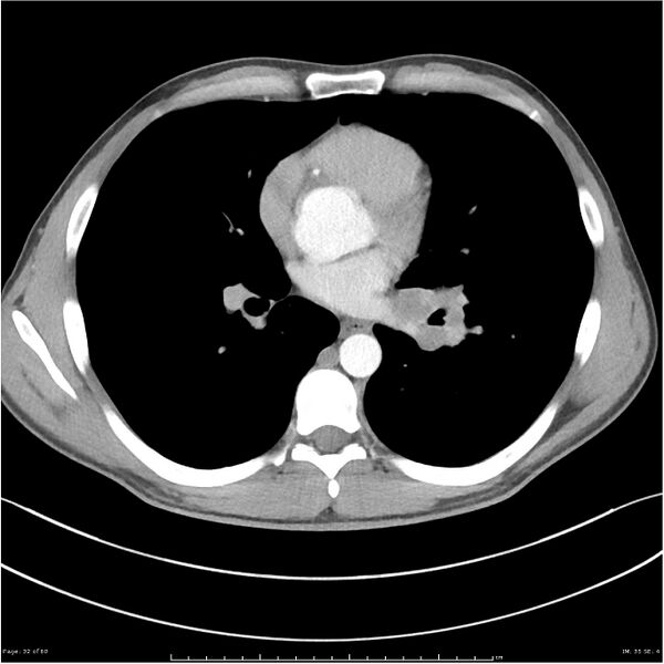 File:Cavitating lung cancer (Radiopaedia 25796-25945 C+ arterial phase 32).jpg