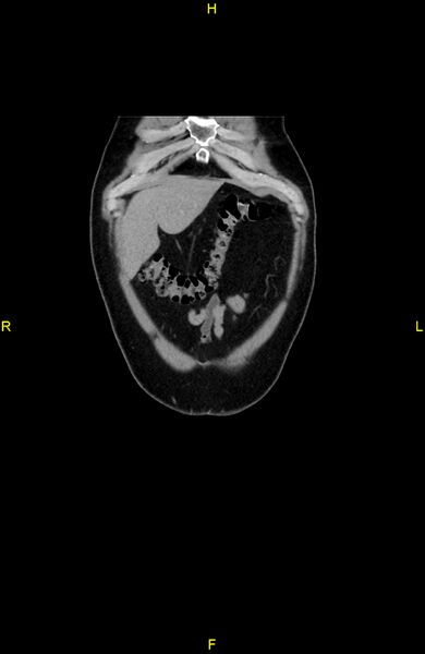 File:Cecal epiploic appendagitis (Radiopaedia 86047-102164 B 11).jpg