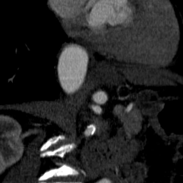File:Celiac artery aneurysm (Radiopaedia 21574-21525 B 6).JPEG