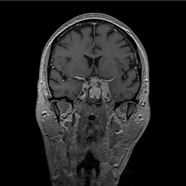 File:Central base of skull meningioma (Radiopaedia 53531-59549 Coronal T1 C+ 11).jpg