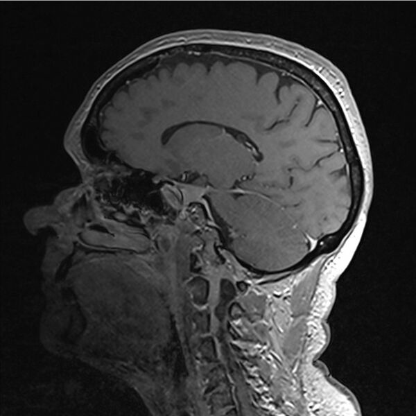 File:Central base of skull meningioma (Radiopaedia 53531-59549 Sagittal T1 C+ 10).jpg