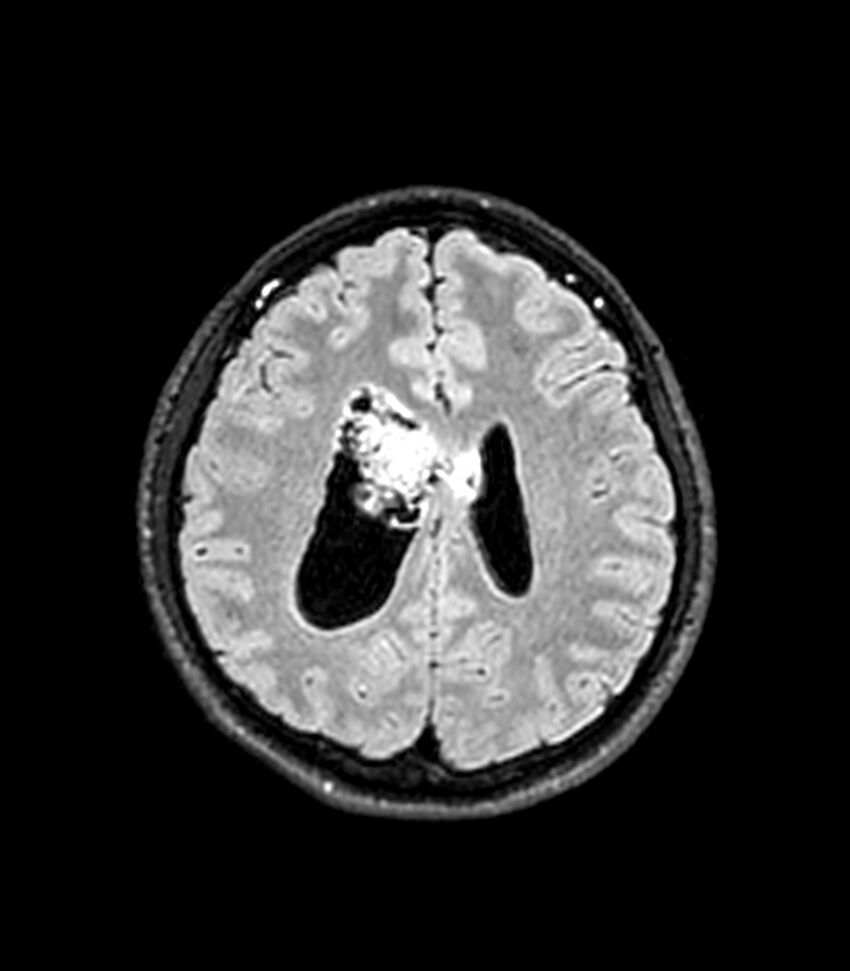 Central neurocytoma (Radiopaedia 79320-92380 Axial FLAIR 112).jpg