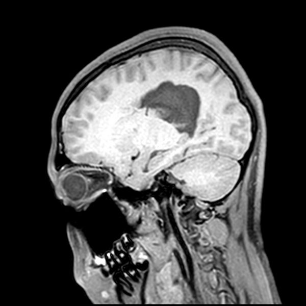 File:Central neurocytoma (Radiopaedia 79320-92380 Sagittal T1 173).jpg