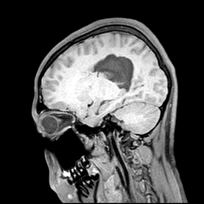 Central neurocytoma (Radiopaedia 79320-92380 Sagittal T1 173).jpg