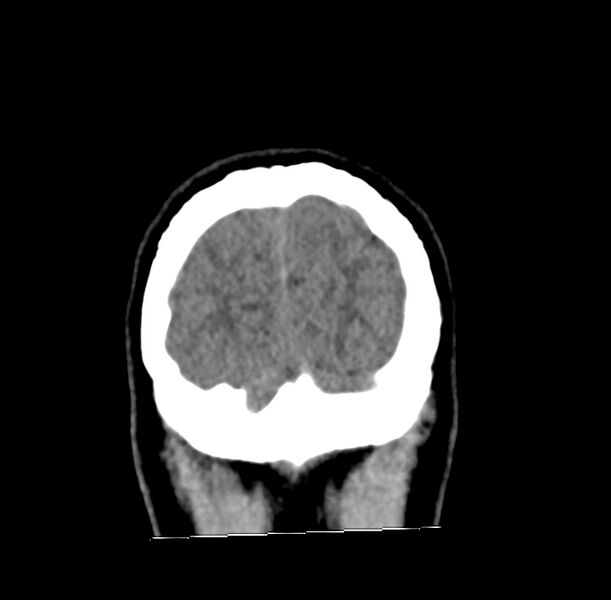 File:Cerebellar agenesis (Radiopaedia 30203-30817 Coronal non-contrast 47).jpg