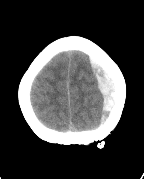 File:Cerebellar ependymoma complicated by post-operative subdural hematoma (Radiopaedia 83322-97737 Axial non-contrast 6).png