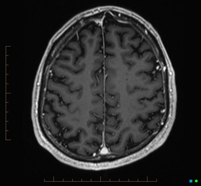 File:Cerebellar gangliocytoma (Radiopaedia 65377-74422 Axial T1 C+ 107).jpg