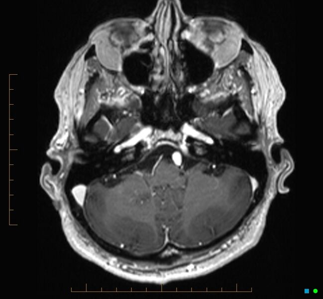 File:Cerebellar gangliocytoma (Radiopaedia 65377-74422 Axial T1 C+ 21).jpg