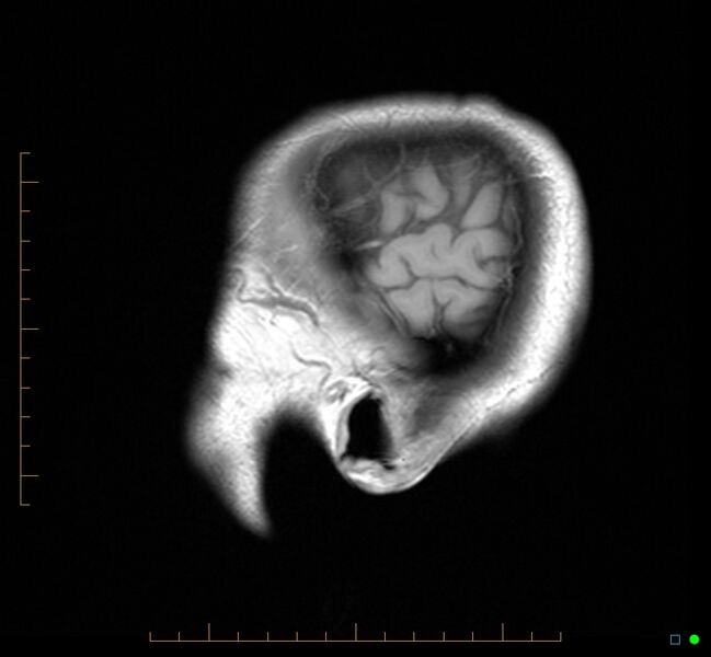 File:Cerebellar gangliocytoma (Radiopaedia 65377-74422 Sagittal T1 1).jpg