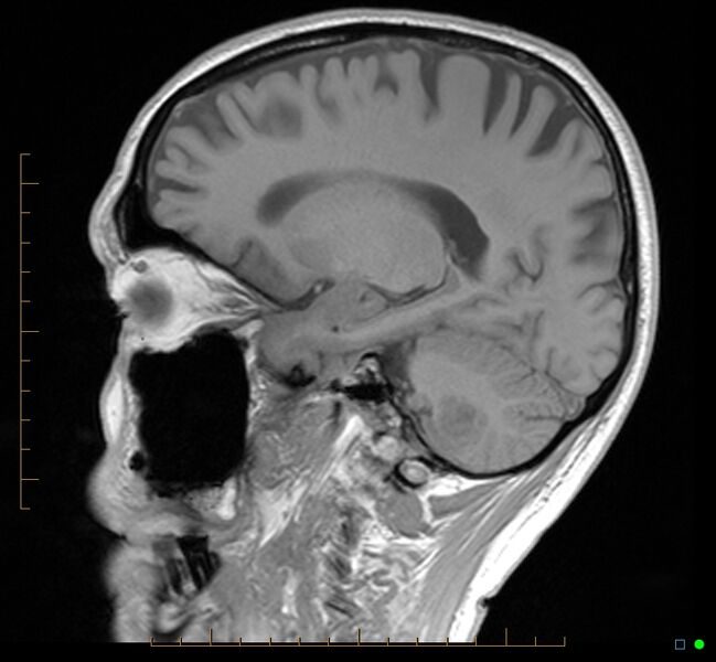 File:Cerebellar gangliocytoma (Radiopaedia 65377-74422 Sagittal T1 15).jpg
