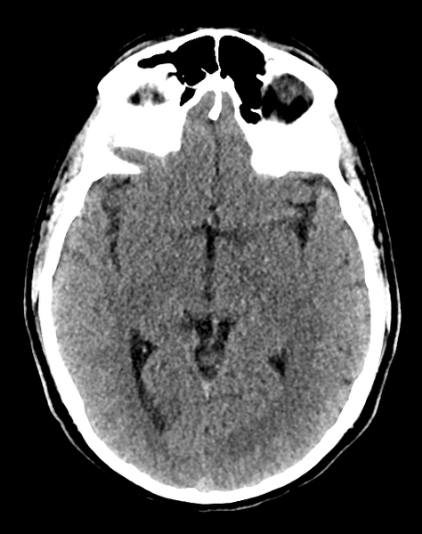File:Cerebellar infarct due to vertebral artery dissection with posterior fossa decompression (Radiopaedia 82779-97033 Axial non-contrast 17).png