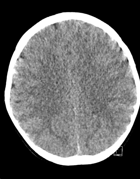 File:Cerebellar stroke (Radiopaedia 32202-33149 Axial non-contrast 18).png