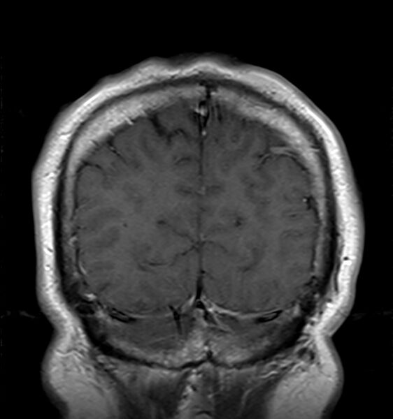 File:Cerebellopontine angle meningioma (Radiopaedia 24459-24764 Coronal T1 C+ 21).jpg