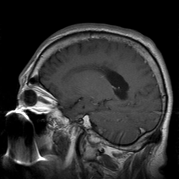 File:Cerebellopontine angle meningioma (Radiopaedia 24459-24764 Sagittal T1 C+ 17).jpg