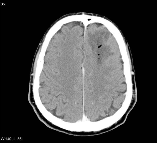 File:Cerebral abscess (Radiopaedia 5150-6933 Axial C+ delayed 4).jpg