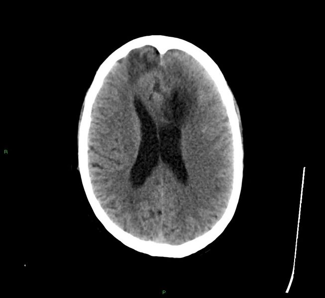 File:Cerebral amyloid angiopathy-associated lobar intracerebral hemorrhage (Radiopaedia 58529-65681 Axial non-contrast 21).jpg
