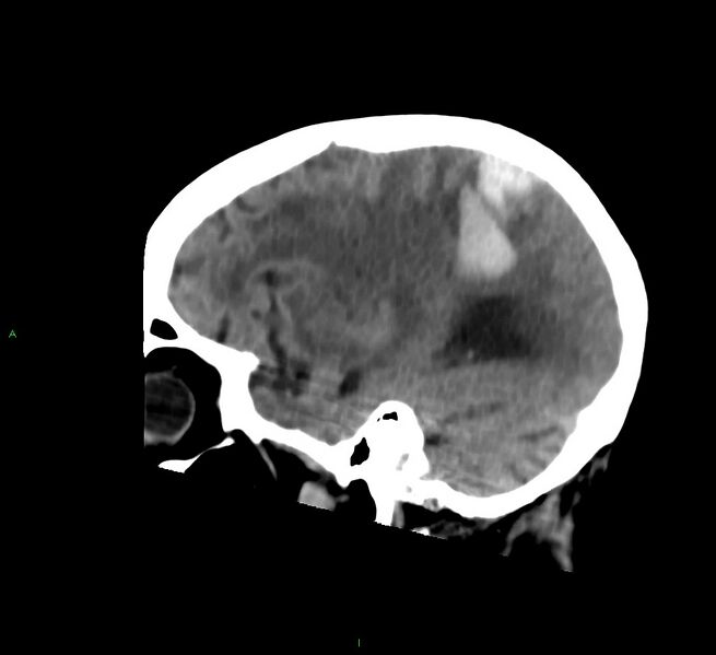 File:Cerebral amyloid angiopathy-associated lobar intracerebral hemorrhage (Radiopaedia 58530-65688 C 39).jpg