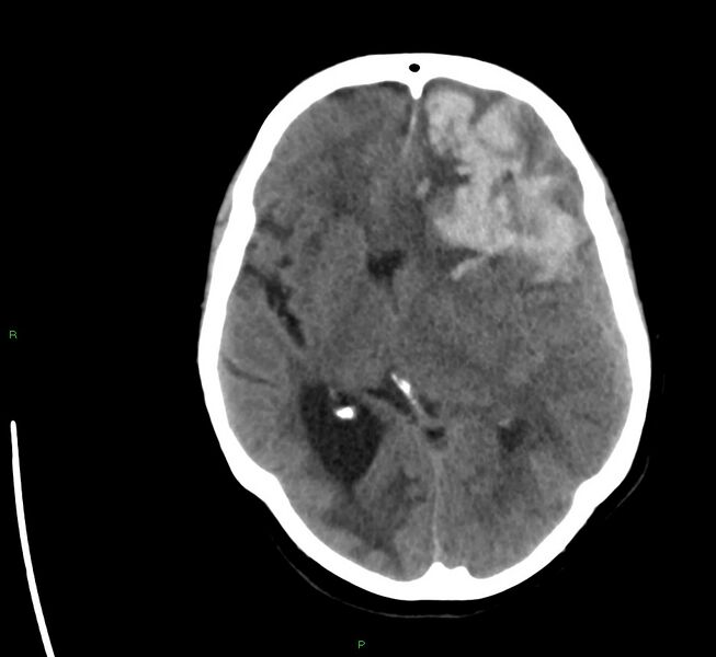File:Cerebral amyloid angiopathy-associated lobar intracerebral hemorrhage (Radiopaedia 58561-65724 Axial non-contrast 25).jpg