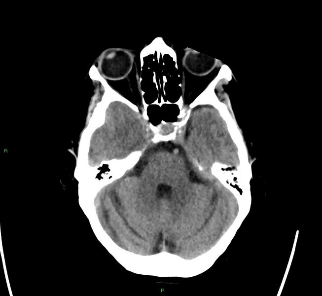 File:Cerebral amyloid angiopathy-associated lobar intracerebral hemorrhage (Radiopaedia 58563-65727 Axial non-contrast 39).jpg