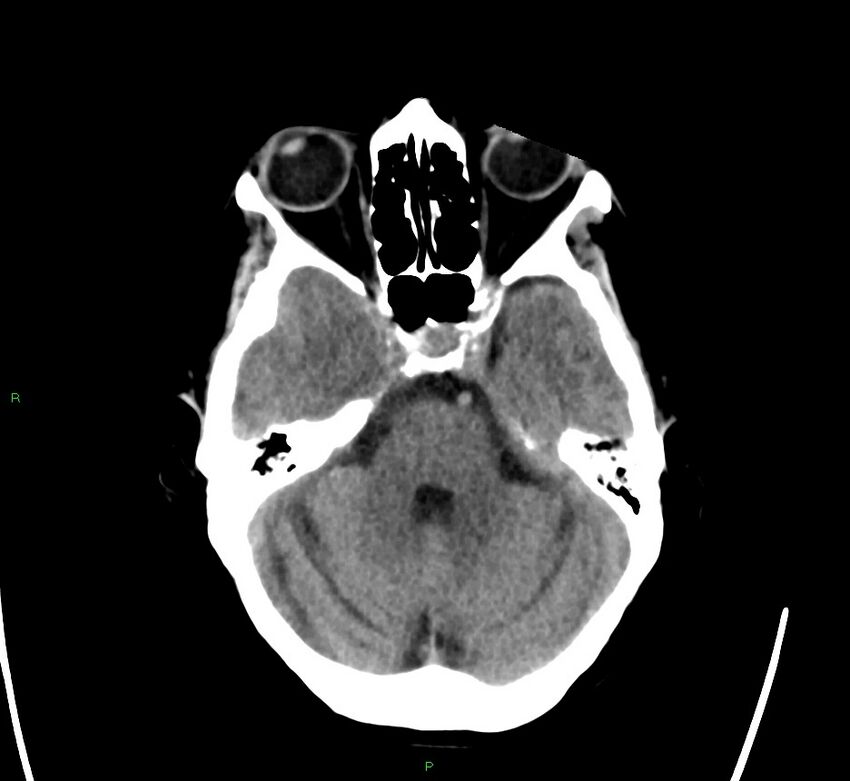 Cerebral amyloid angiopathy-associated lobar intracerebral hemorrhage (Radiopaedia 58563-65727 Axial non-contrast 39).jpg