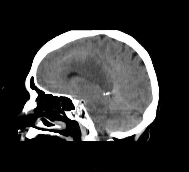 File:Cerebral amyloid angiopathy-associated lobar intracerebral hemorrhage (Radiopaedia 58751-65972 C 31).jpg