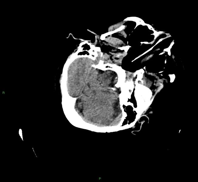 File:Cerebral amyloid angiopathy-associated lobar intracerebral hemorrhage (Radiopaedia 58757-65979 Axial non-contrast 36).jpg
