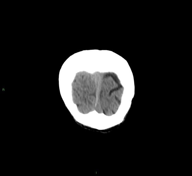 File:Cerebral amyloid angiopathy-associated lobar intracerebral hemorrhage (Radiopaedia 58758-65980 Coronal non-contrast 7).jpg